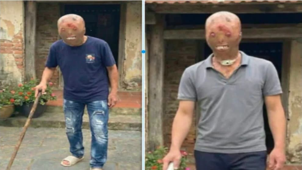 खौलते पानी को समझा ठंडा, एक लोटे ने बदल दी पूरी जिंदगी; युवक का चेहरा बुरी तरह झुलसा