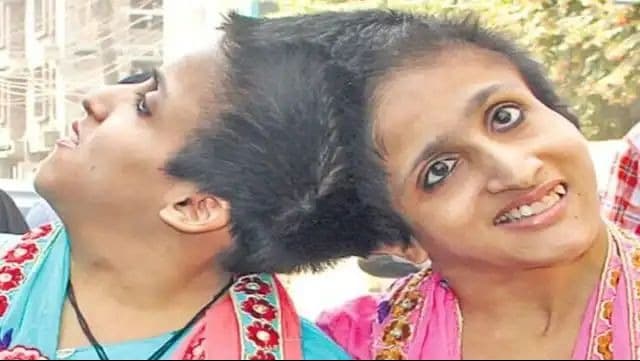 ना दवाएं मिलीं ना डॉक्टरों ने जांच की, सिर से जुड़ी सबा और फराह ठीक से खा नहीं पा रहीं; SC का आदेश भी बेअसर